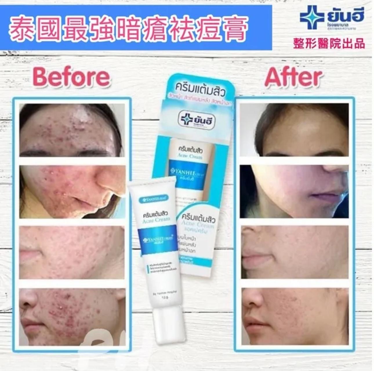 現貨❤️泰國🇹🇭著名Yanhee 整容醫院出品 暗瘡膏10g